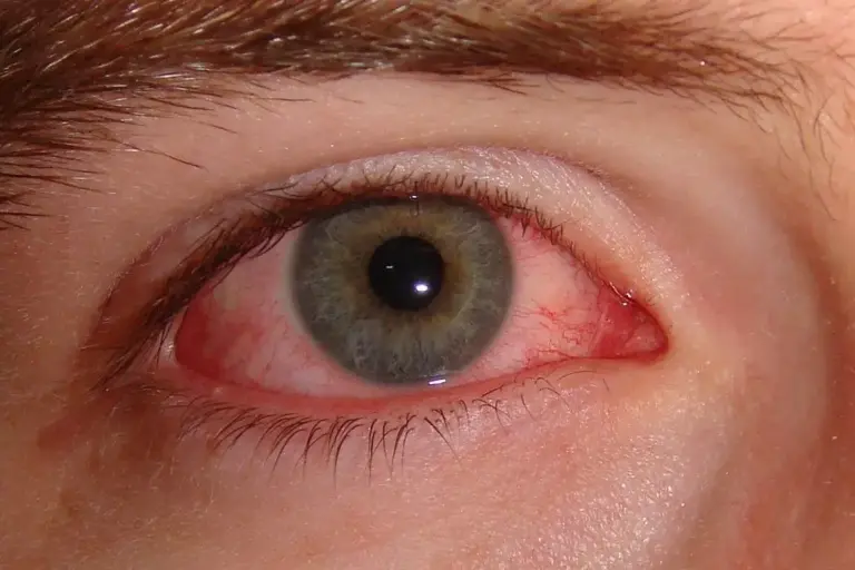 San Miguelito Health Region Reports Over 500 Conjunctivitis Cases in 2025 Pink eye