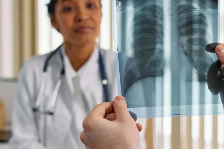 85% of Panama Lung Cancer Cases Diagnosed Late lunge xray