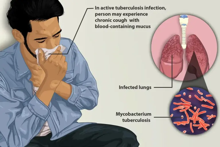Depiction of a tuberculosis patient