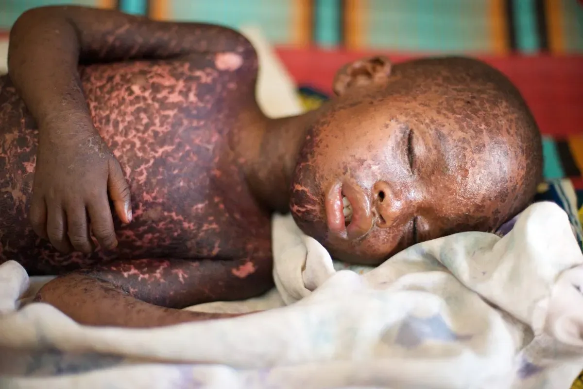 3840px Child with measles