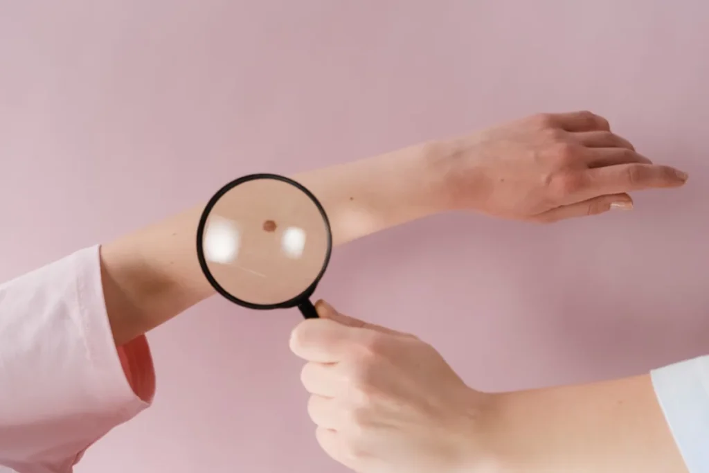 Melanoma skin cancer By Fundation Nexofin.